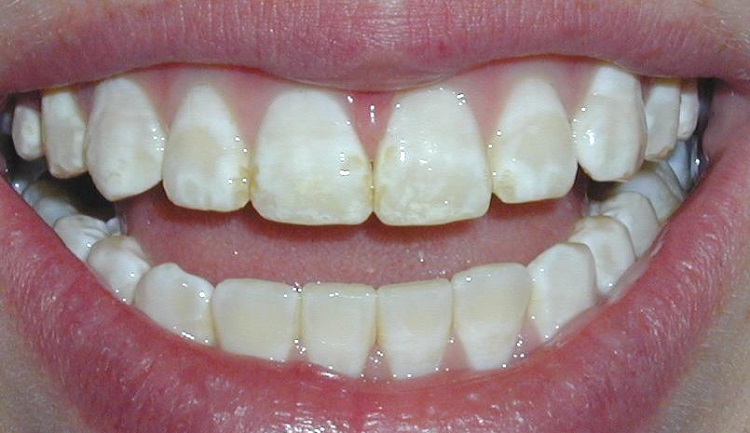 خمیر دندان مناسب افراد سیگاری